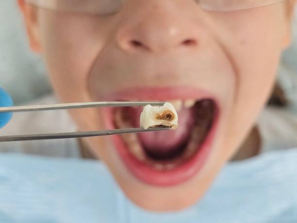 Best Emergency Root Canal Treatment in Piketon, OH